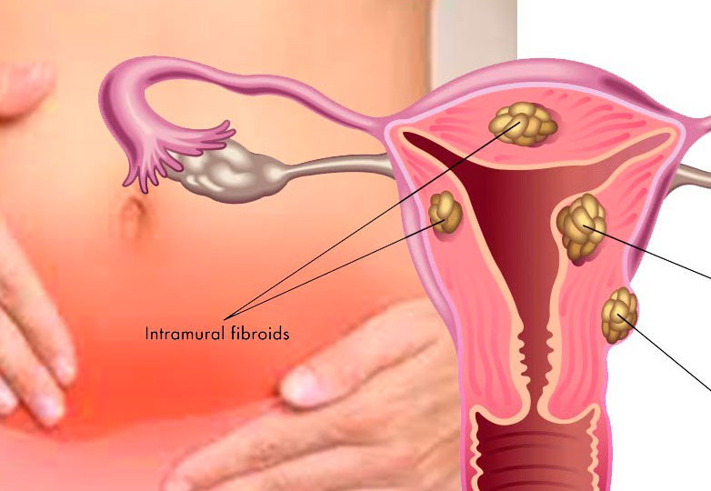 mioma uterino tratamiento